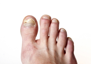 Understanding Fungal Nail Infections