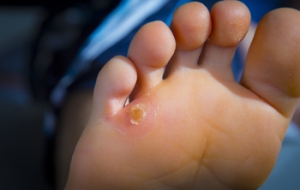 Types Of Corns On The Feet
