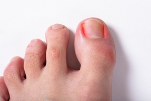 Ingrown Toenails in Children